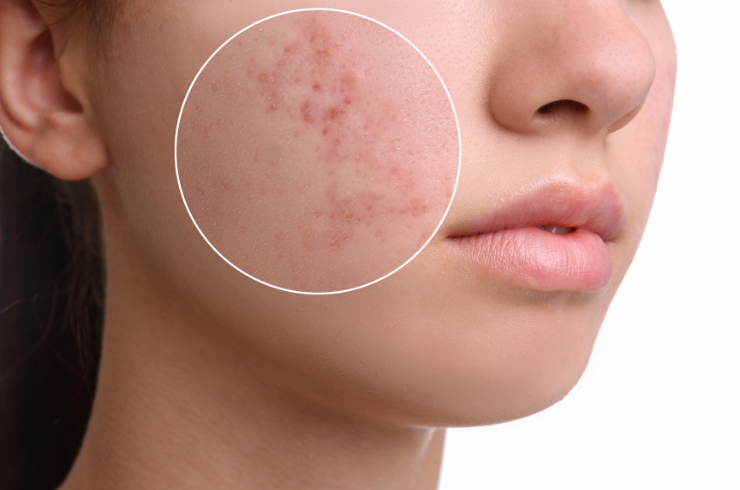 Dermatology